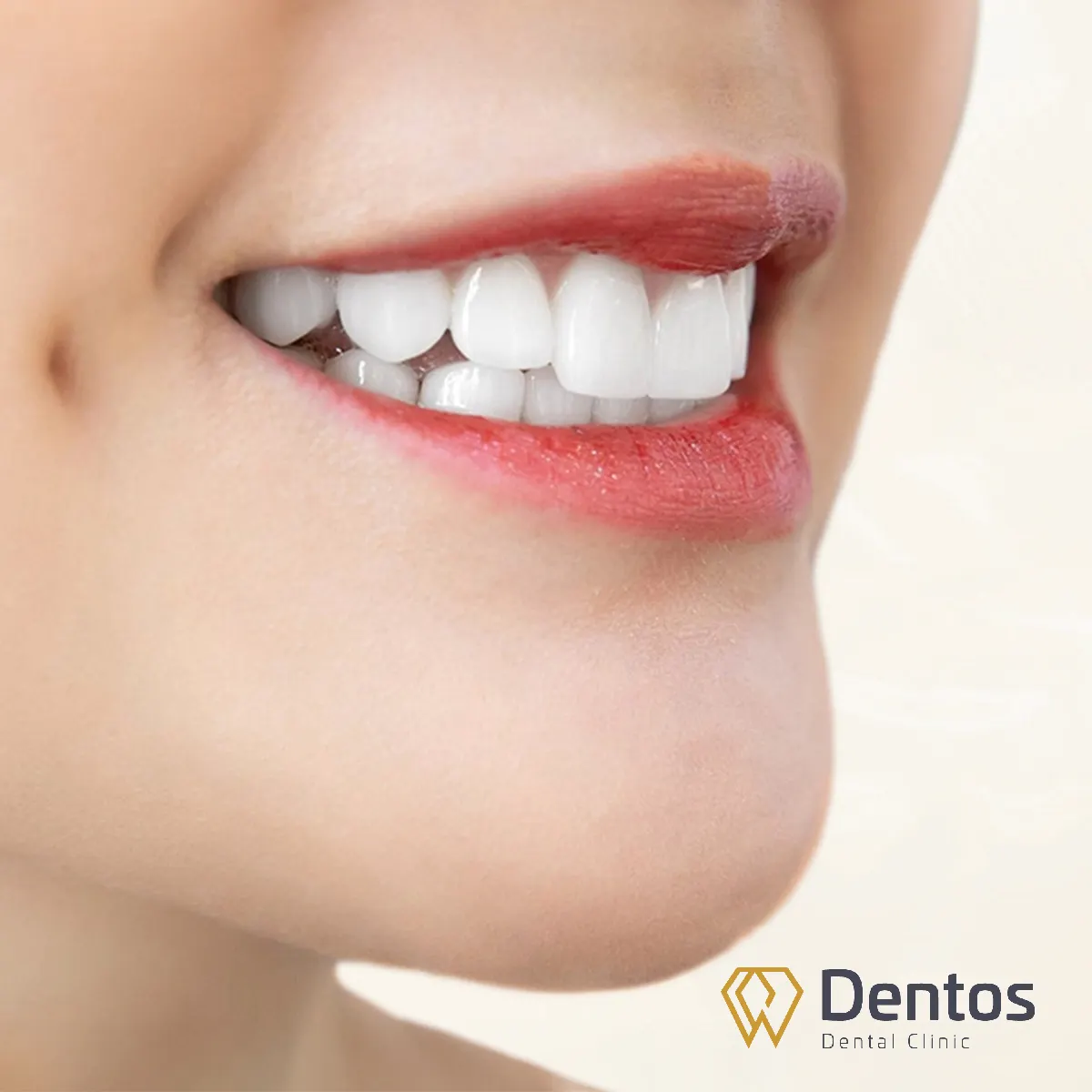 Răng toàn sứ DDBio sở hữu tính tương thích sinh học cao